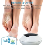 Lima Eléctrica Recargable para Pies con Aspiradora - Removedor de Callos para Piel Suave y Exfoliada Lima Eléctrica Recargable para Pies con Aspiradora - Removedor de Callos para Piel Suave y Exfoliada