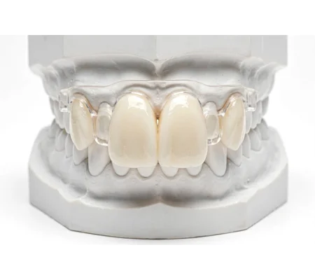 Bucked teeth