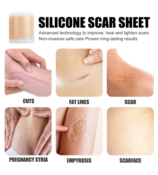 Self-Adhesive Silicone Scar Sheets – Cut-to-Fit Scar Care Strips – FREE SHIPPING