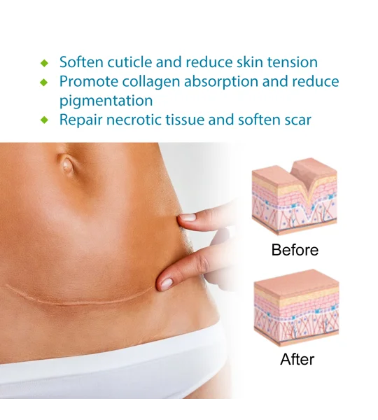 Self-Adhesive Silicone Scar Sheets – Cut-to-Fit Scar Care Strips – FREE SHIPPING