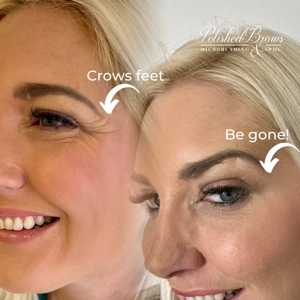 Anti Wrinkle Injections