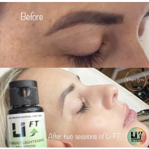 LiFT Saline Tattoo Removal