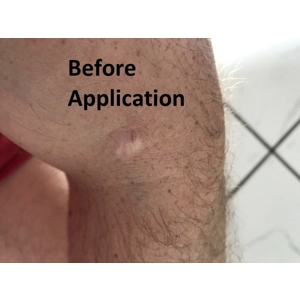 Keloid Dissolve Gel - madecassoside - Hypertrophic Scars