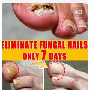 Eliminate Fungal Nails After 7 Days