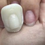 Custom Nail Impression Sizing Kit