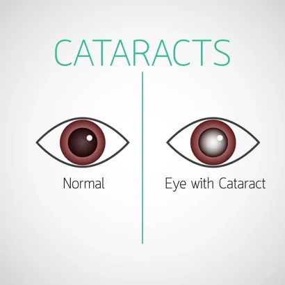 What are Cataracts?