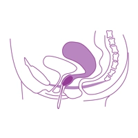 Medenične uteži, I. stopnja, Vaginalne jajčke za keglove vaje