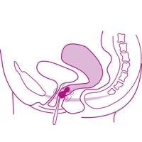 Medenične uteži II. stopnja, Elanee