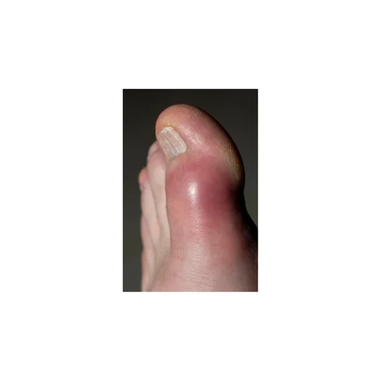 Gout Away Cream. Holistic natural support