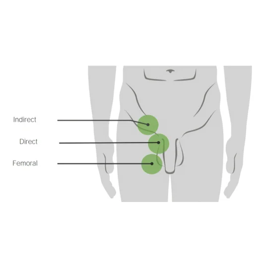 Inguinal Hernia Massage Cream. Holistic femoral/inguinal hernia pain support cream