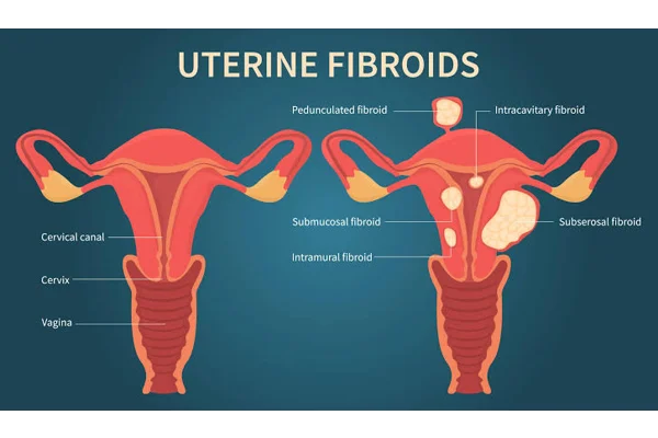 Understanding Uterine Fibroids: What Every Woman Should Know