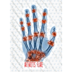 Arthritis Flare Up