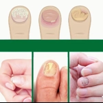 72 Patches Nail Care Set 72 Patches Nail Care Set