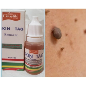 1x SKIN TAG Remover The natural way Spots Mole Freckles Et..
