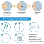 Wart Remover Wart Remover