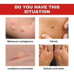 Ximonth 20ml/Bottle Anti Mole And Wart Ximonth 20ml/Bottle Anti Mole And Wart