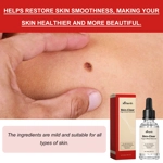 Ximonth 20ml/Bottle Anti Mole And Wart Ximonth 20ml/Bottle Anti Mole And Wart