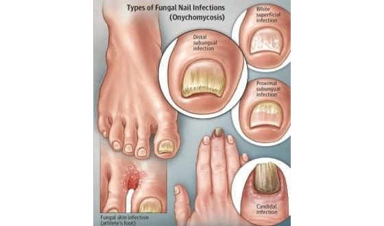Category Image for Foot Treatments